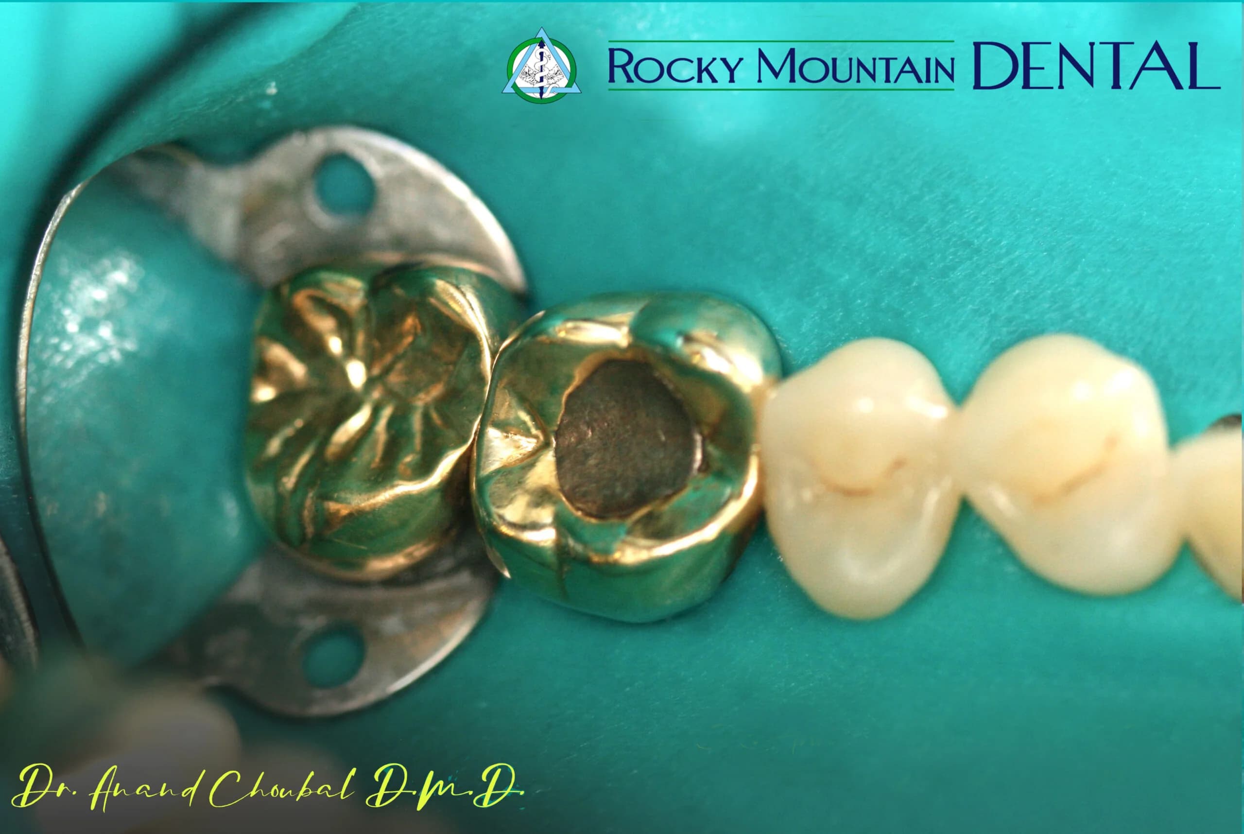 Cosmetic Front Tooth Repair