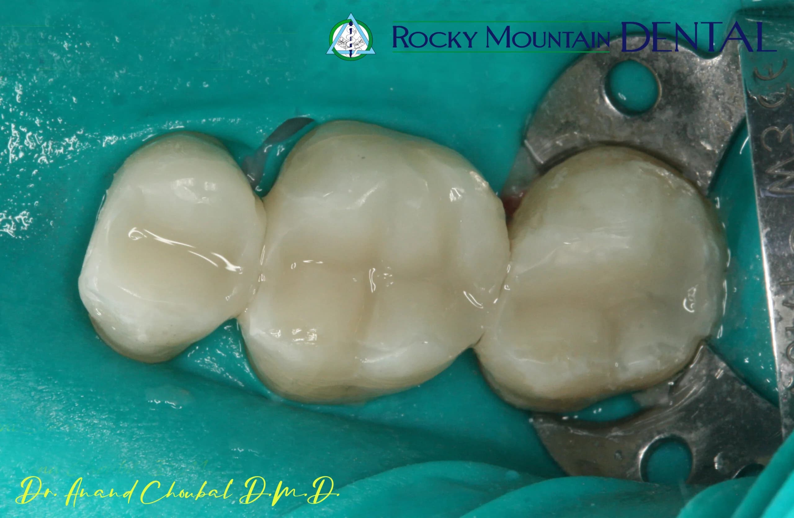 Single Tooth Implant