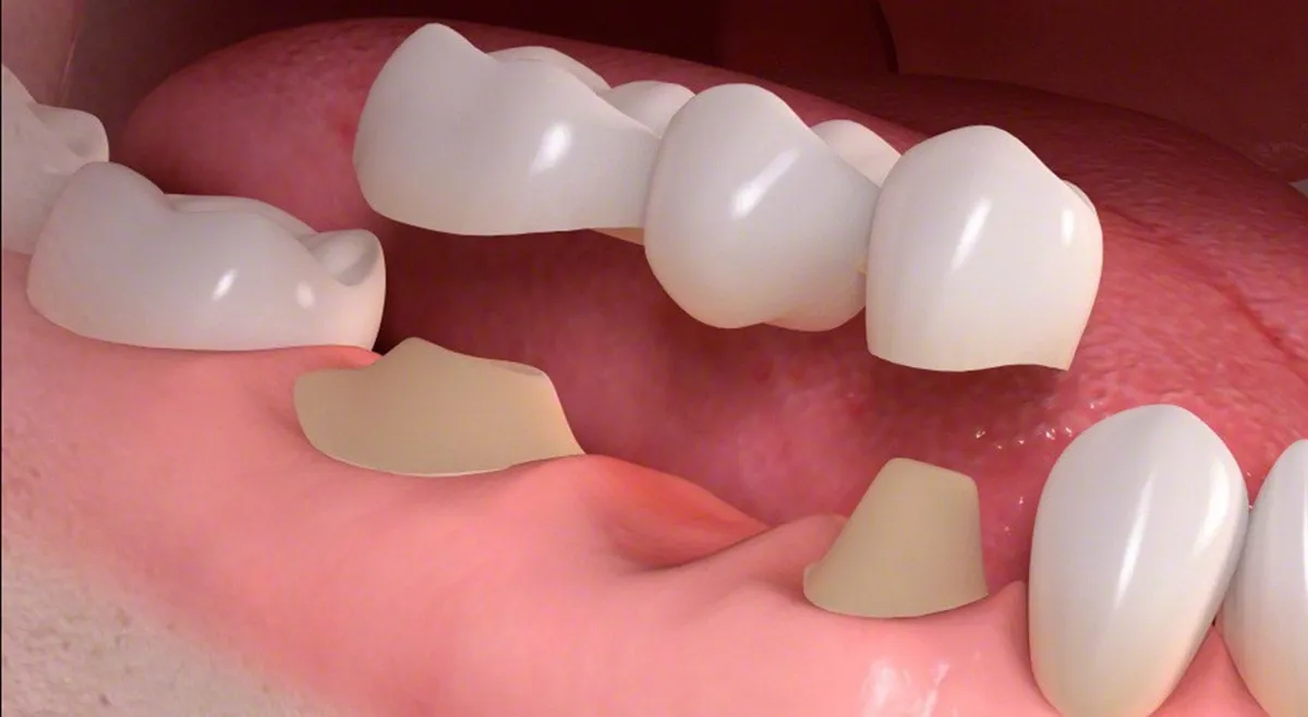 Dental crown and bridge restorations in Banff