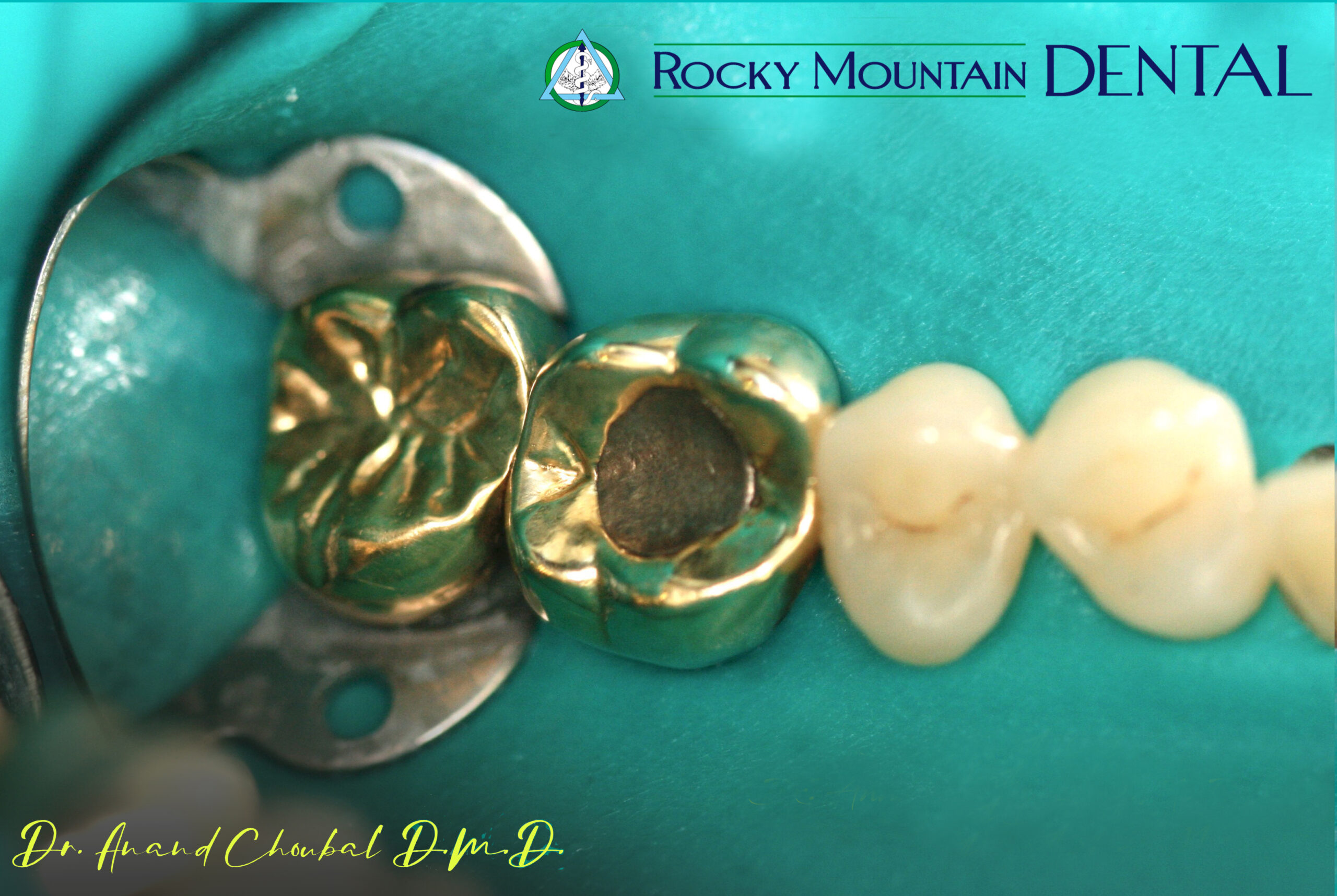 Cosmetic Front Tooth Repair