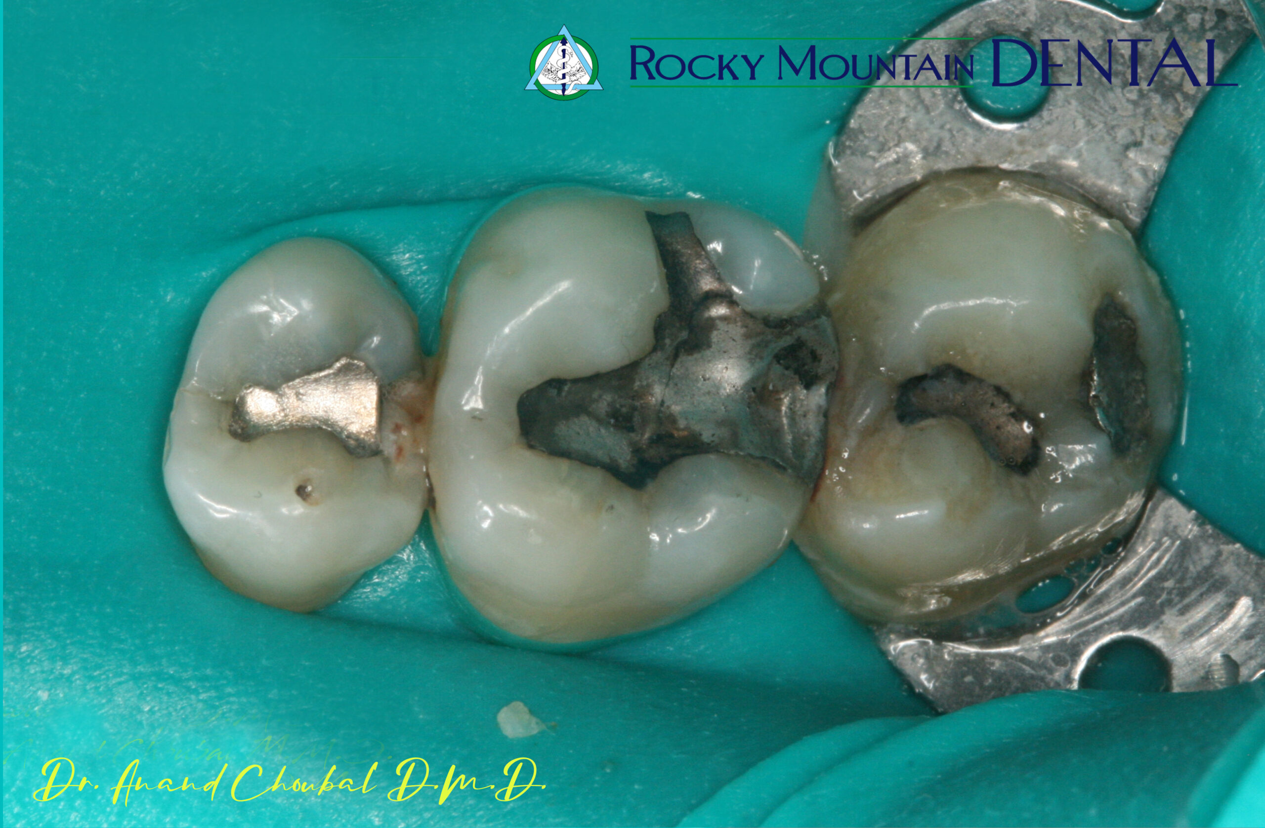 Full Mouth Restoration