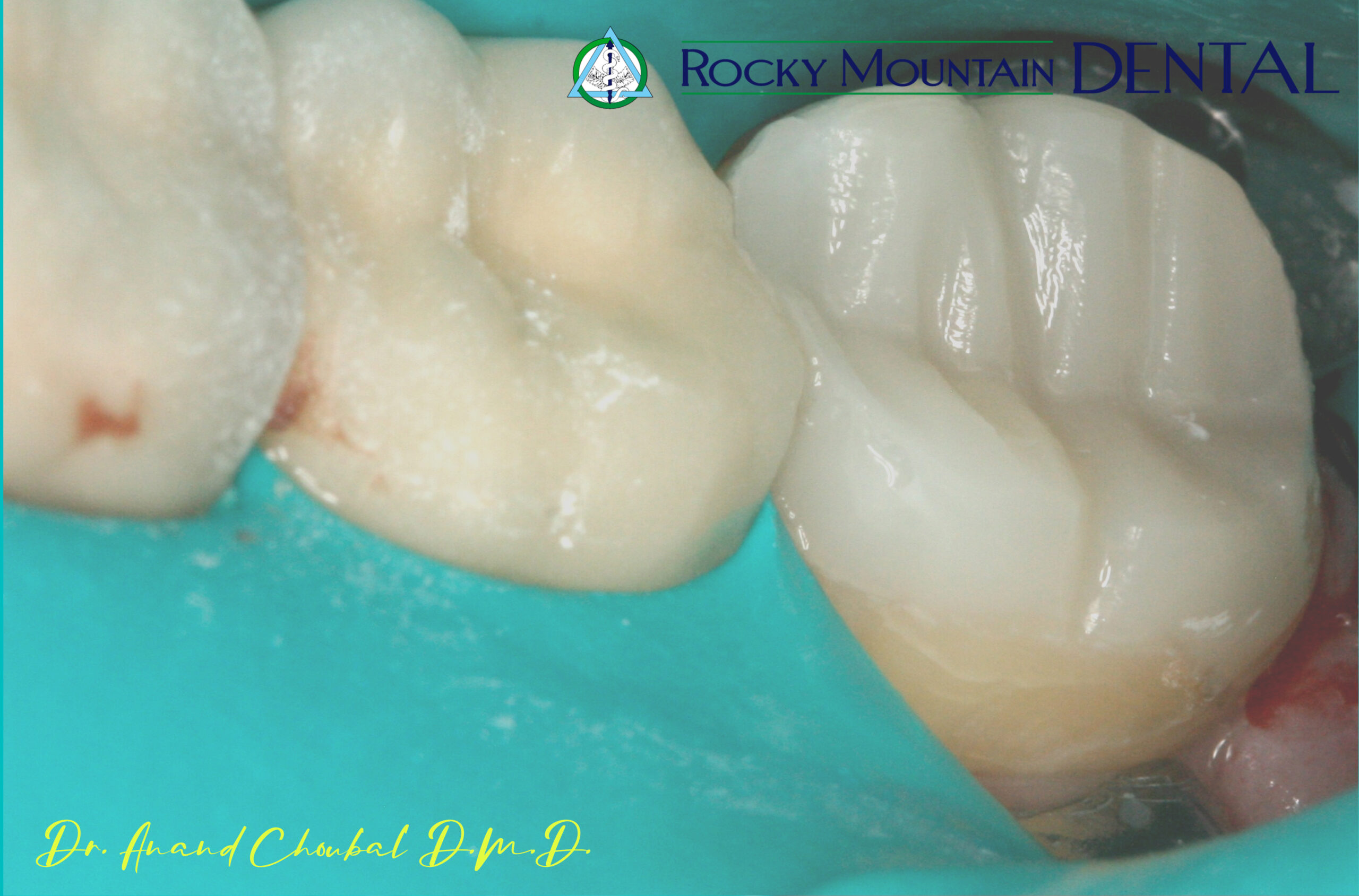 Gum Disease Recovery